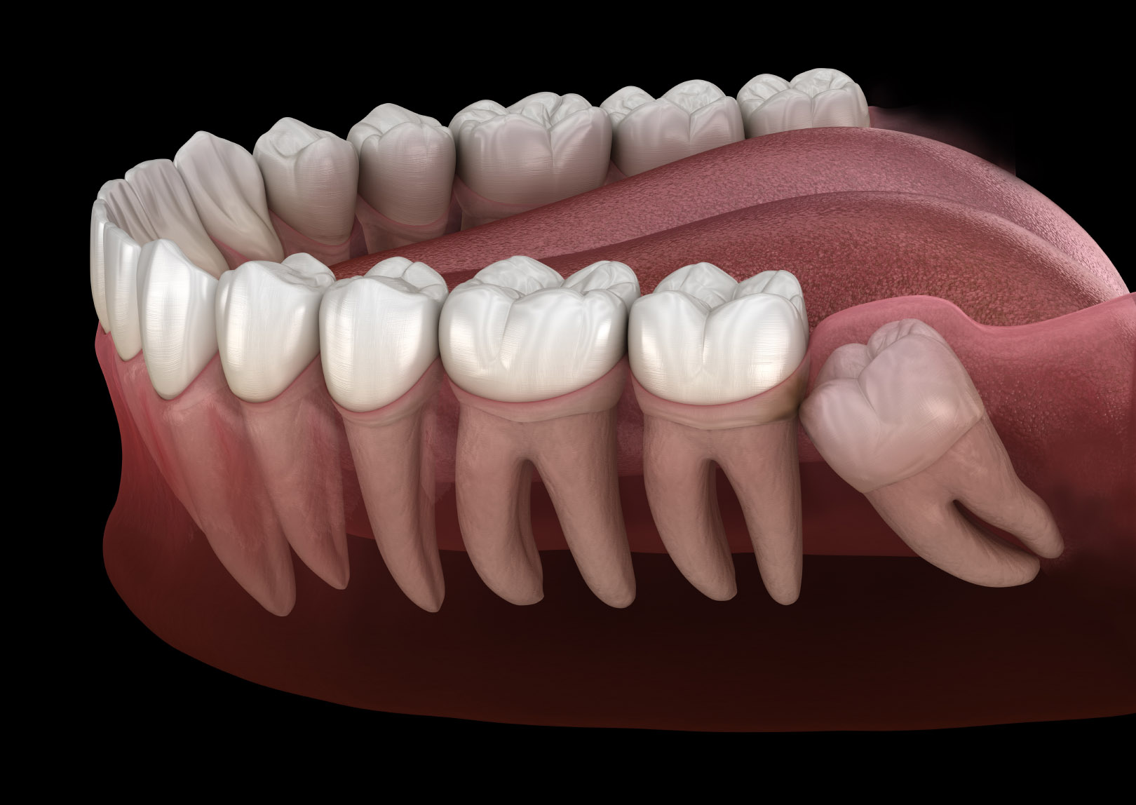 Tooth Extraction Hixson, TN