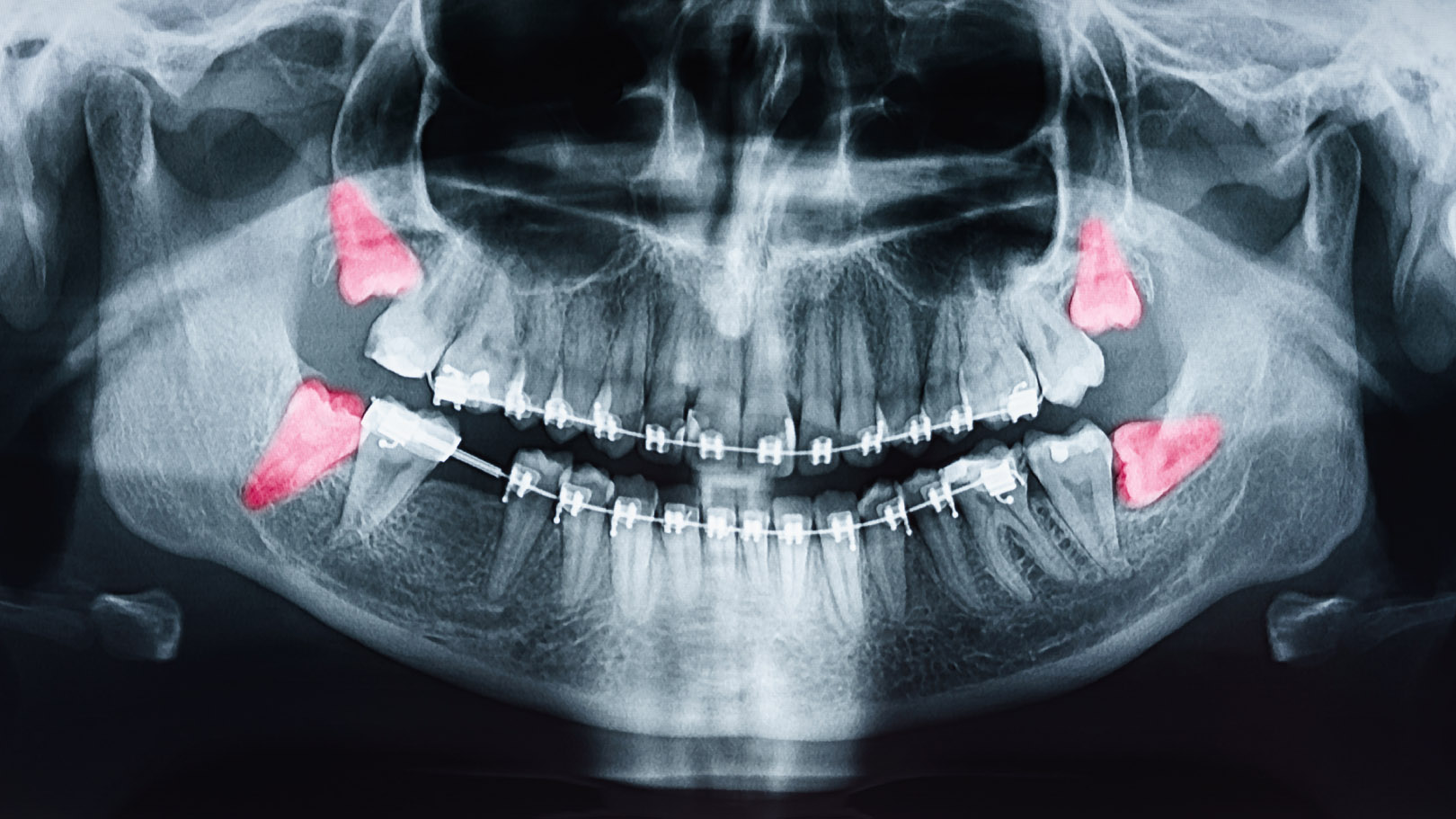Tooth Extraction Hixson, TN