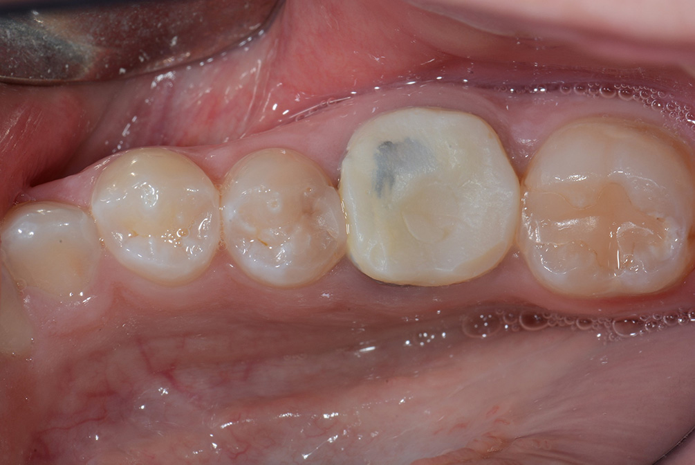 Same Day Implants: Molar Before Hixson, TN