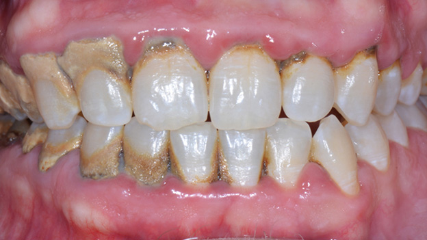Gum Disease Case Before Hixson, TN